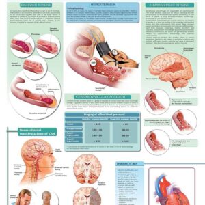 stroke - A personal story